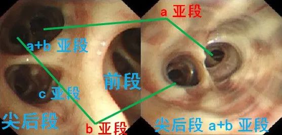 42个支气管亚段,如何实现精准定位?