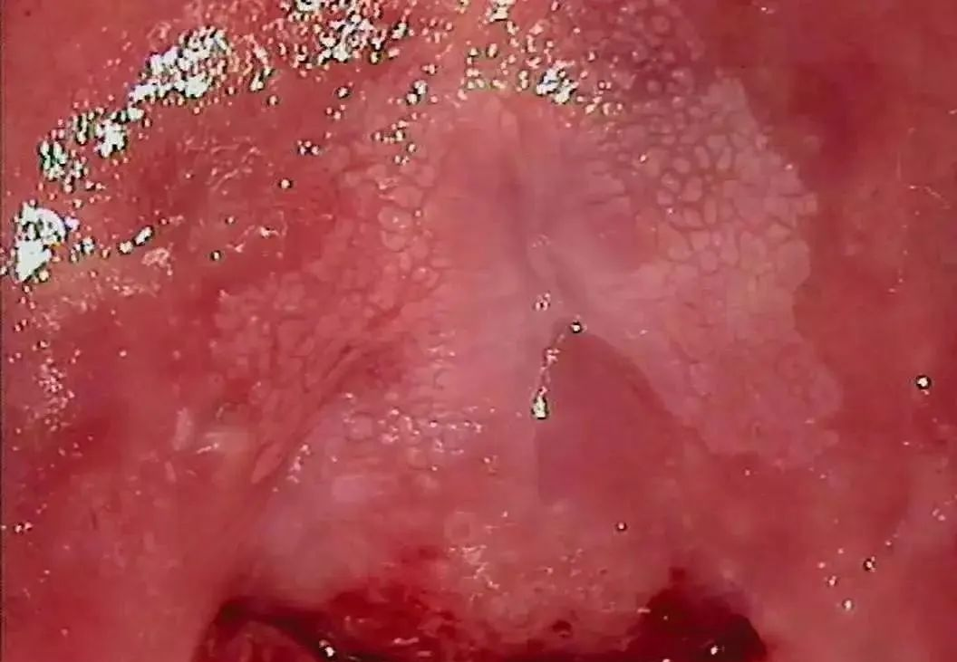 阴道镜下多种异常宫颈图像解析,助你全面了解宫颈健康!