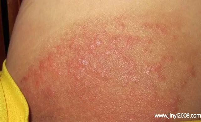 艾灸后皮肤痒还能继续做吗(艾灸什么时候灸比较好)