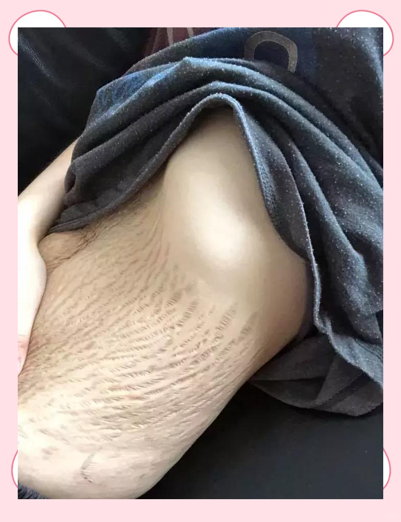 产后肚皮的真实状态与妊娠纹的成因及预防