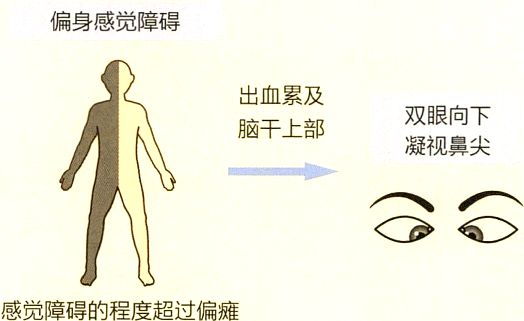 丘脑出血的患者常常会出现偏身感觉障碍,这种障碍有时甚至会比偏瘫更