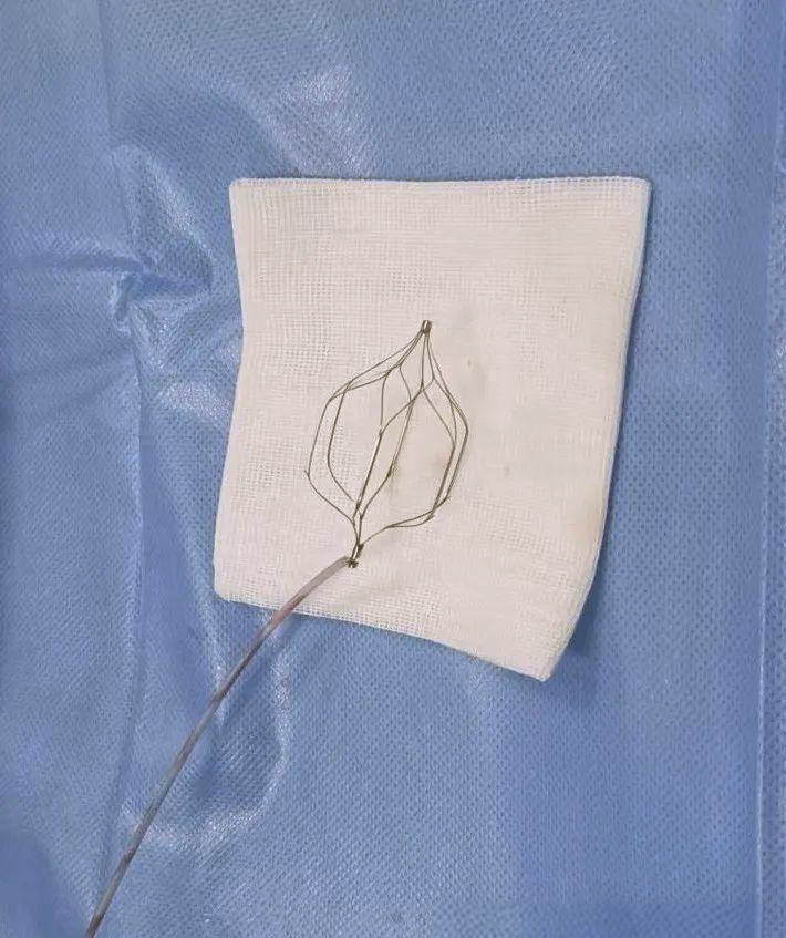 下腔静脉滤器:预防下肢深静脉血栓的生命守护者