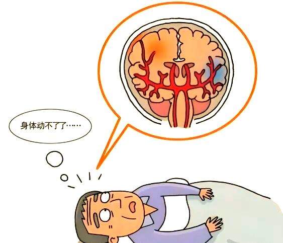 脑梗偏瘫康复有讲究：这4个常见“坑”请留意