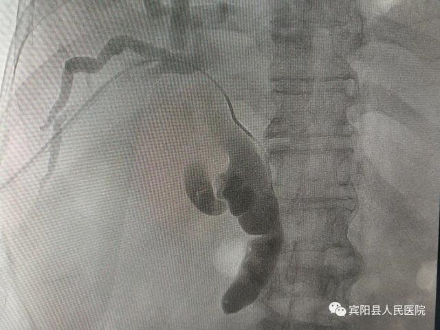 賓陽縣人民醫院醫務人員成功為一梗阻性黃疸患者植入膽道支架