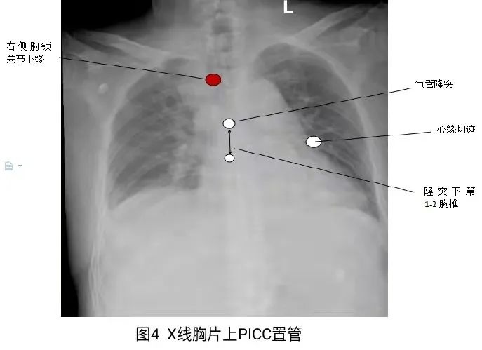 picc置管胸片正确位置图片