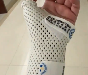 女子睡觉被15斤猫咪压住致手腕骨折 当事人：医生都不相信