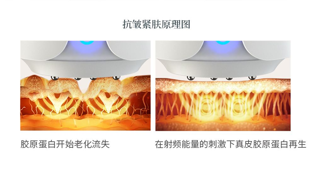 射频美容真的能把你的皱纹"熨平"吗?
