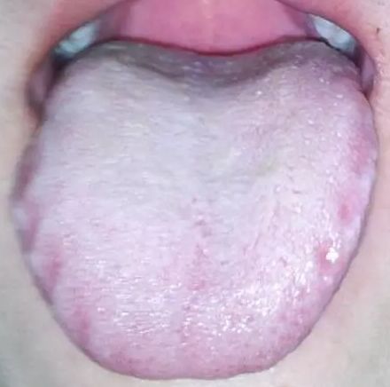 舌苔又白又厚,身体出了什么问题?