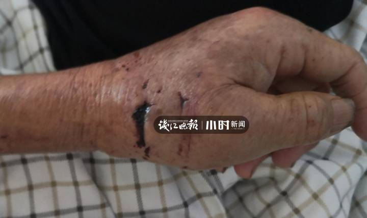 临安西部山村,老妇被神秘动物咬成重伤;有村民说,可能是狼或豺