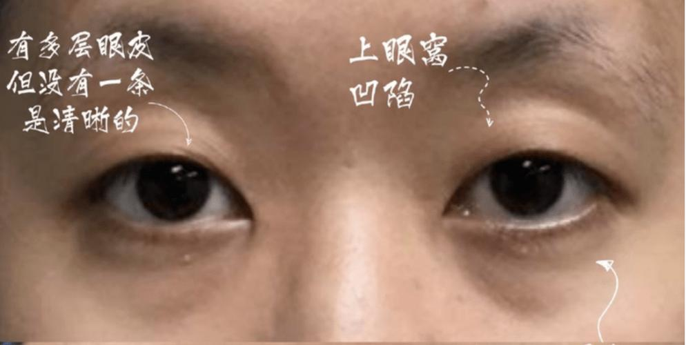 锁骨菱形窝的影像特征与鉴别诊断详解