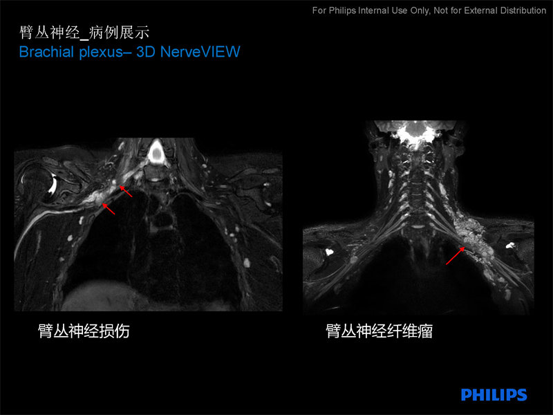 臂丛神经扫描方案|磁共振规范化扫描方案|飞利浦