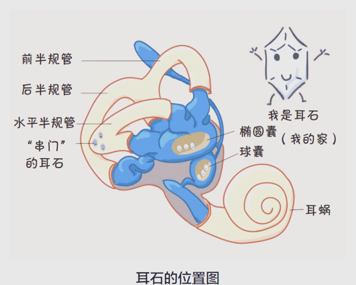 耳石症:病因,症状与治疗全解析