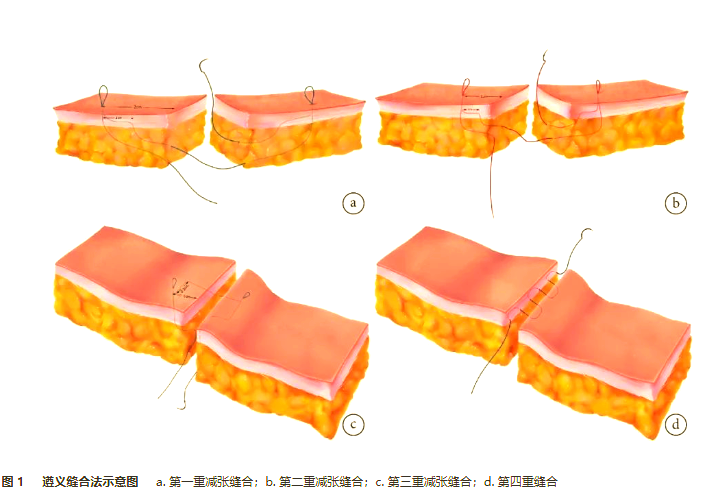 深层减张缝合技术详解与多种示例