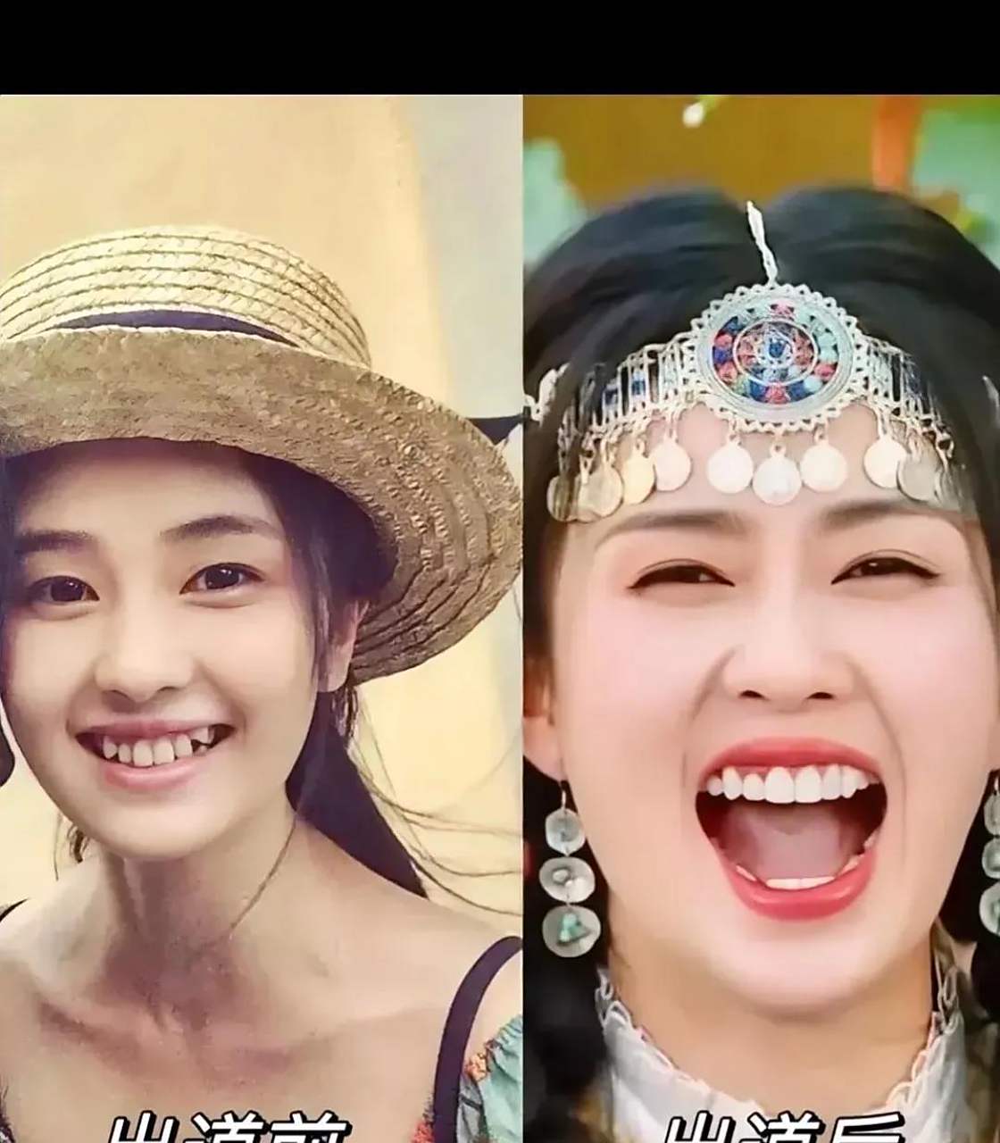 白鹿  牙齿变整齐了,小虎牙不见了  是做了牙齿矫正手术吗?