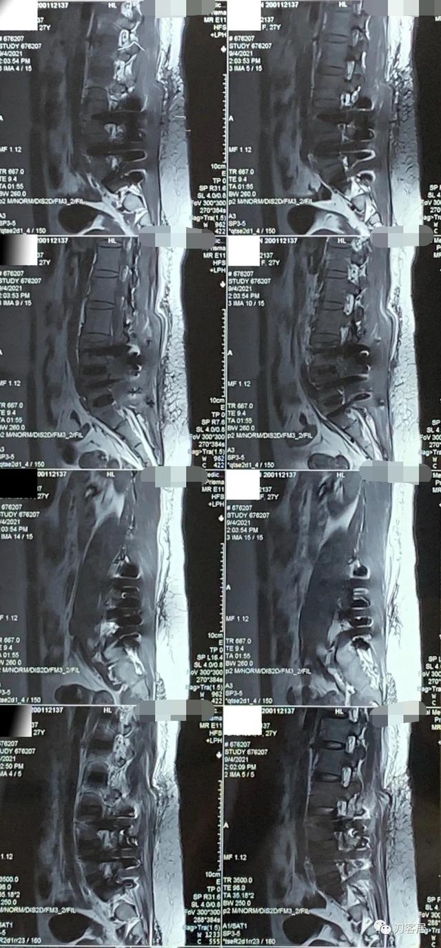 女性腰椎间盘膨出图片图片