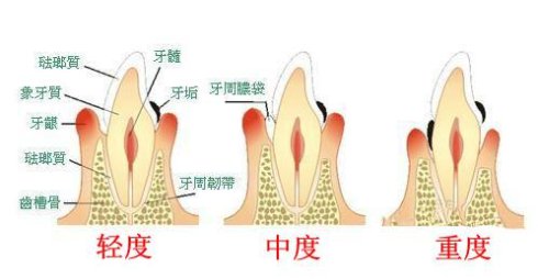 有哪几种牙齿不得不拔除?