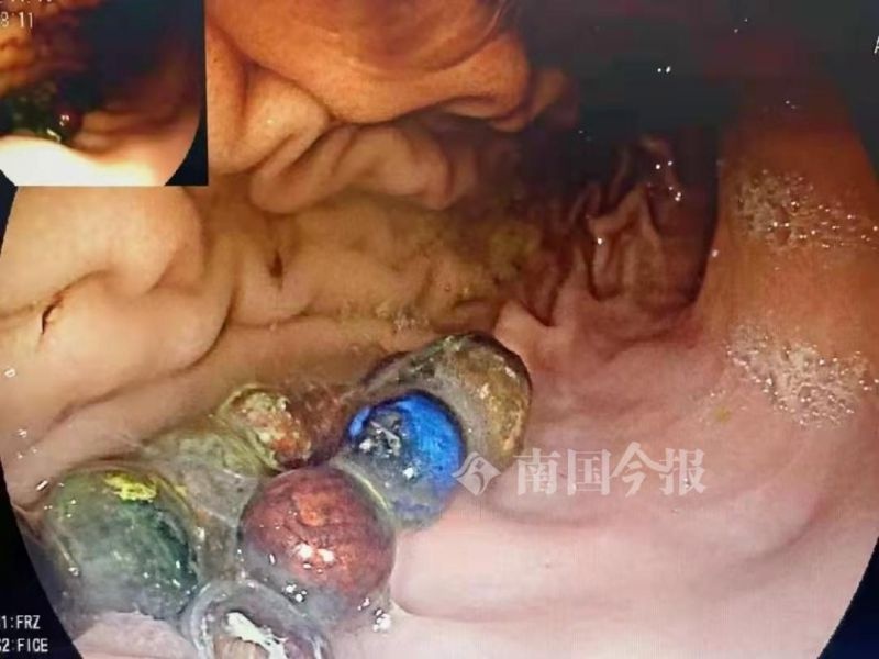 吓死人!柳州一男童胃里发现34颗磁珠,医生连夜取出"定时炸弹"