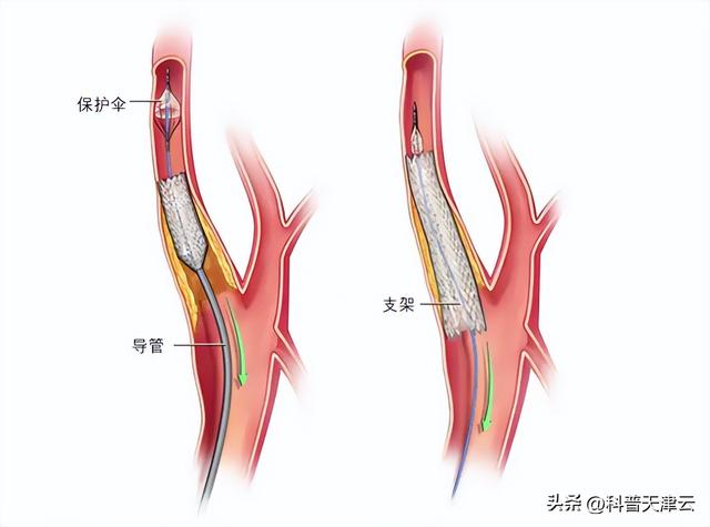 脑梗取栓 挽救生命