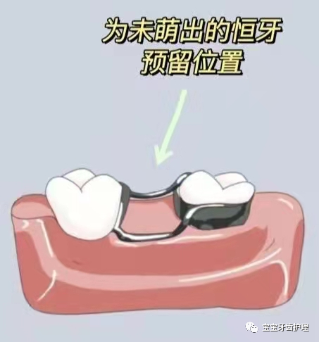 儿童乳牙过早缺失,间隙保持器来帮恒牙占位置