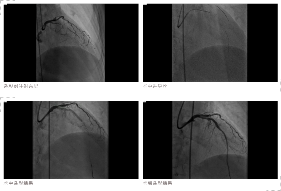 重磅!美敦力第四代resolute onyx支架成功落地吉心