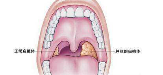 脖子扁桃体图片
