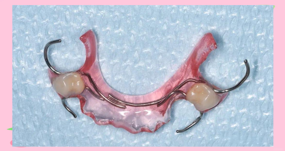 多种间隙保持器在后牙区多颗牙齿缺失中的应用