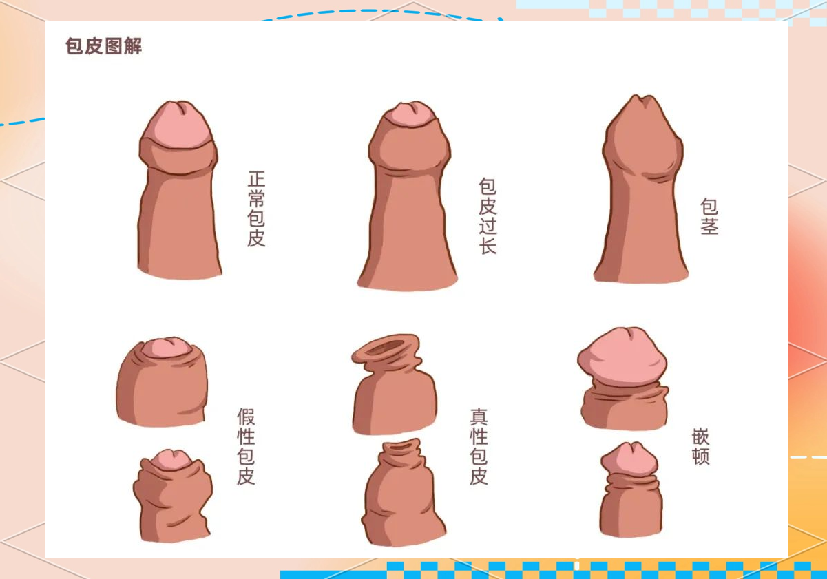 根据医学标准,包皮通常被划分为三种形态:正常包皮,包皮过长以及包 