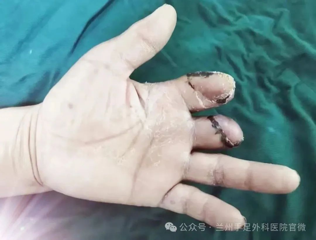 应用废弃指组织选取皮瓣覆盖伤指残端创面
