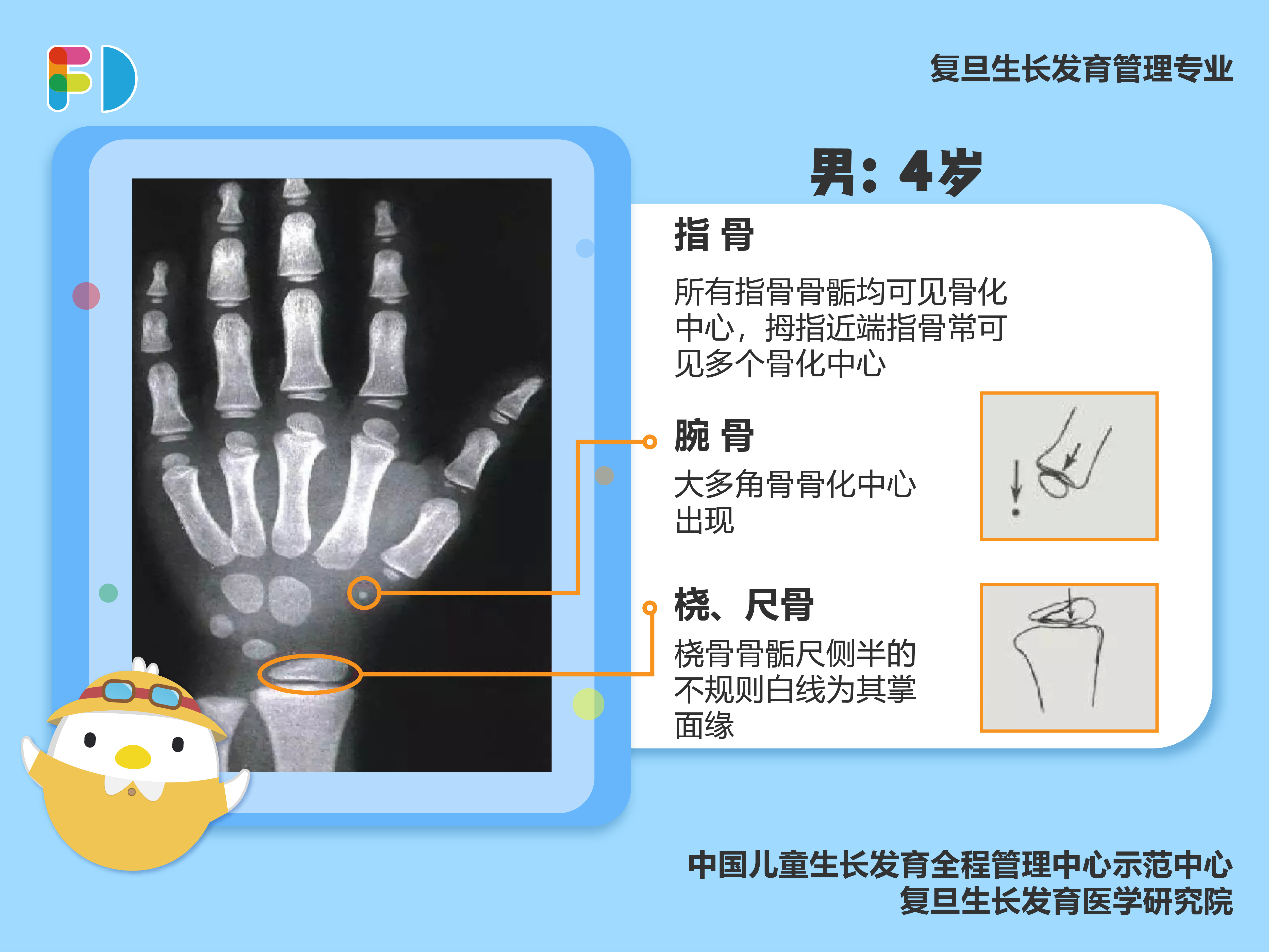 骨龄闭合图对比图片