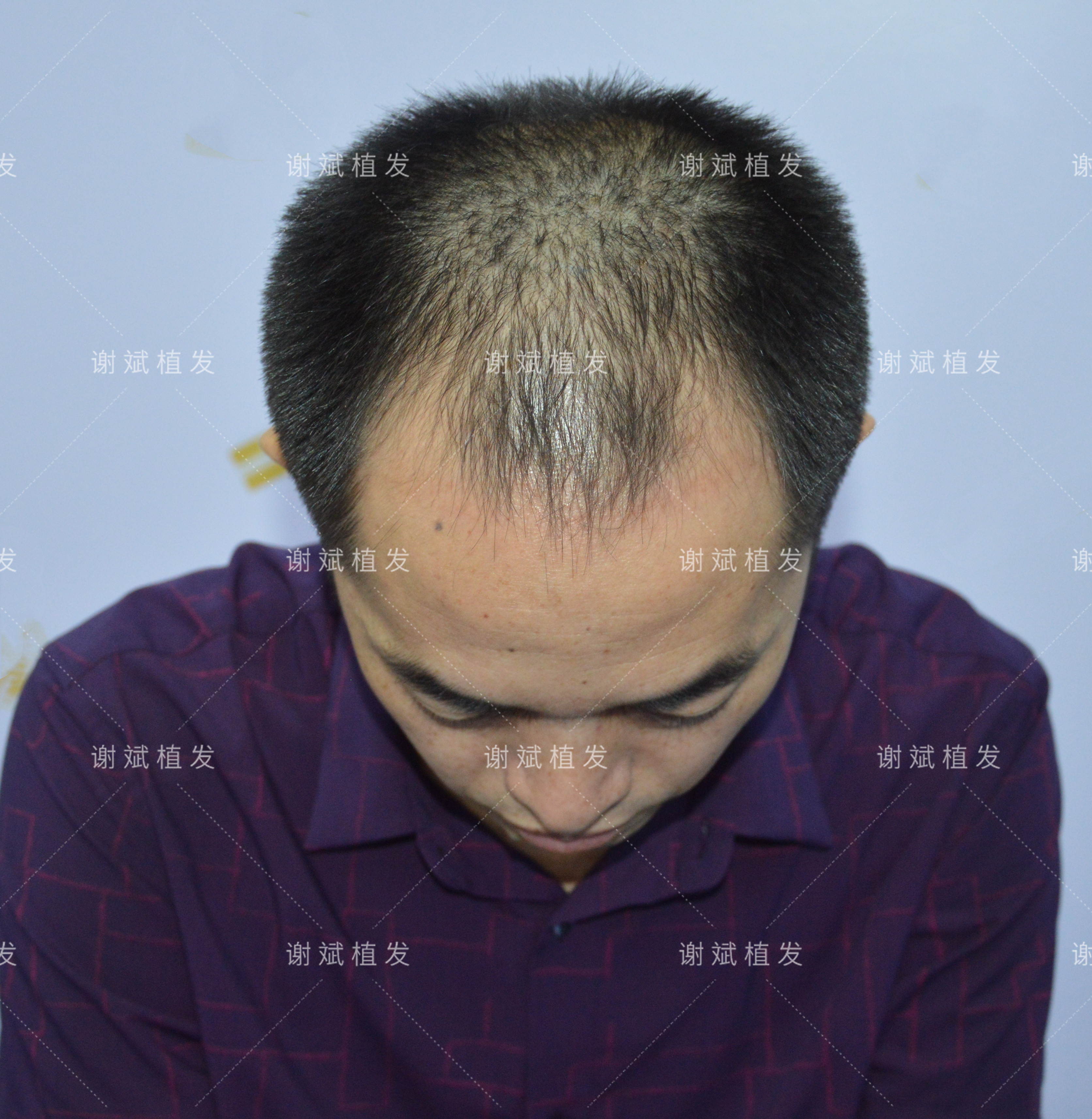 植发工作心得(植发工作心得怎么写)