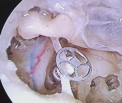 当病变导致镫骨上结构遭受破坏,但镫骨