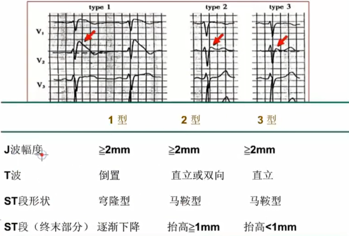心电图st段正常值图解图片