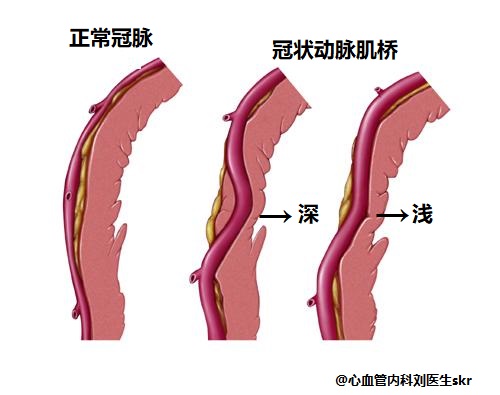 冠状动脉肌桥—有些人可能一辈子与剧烈活动无缘,如何治疗呢?