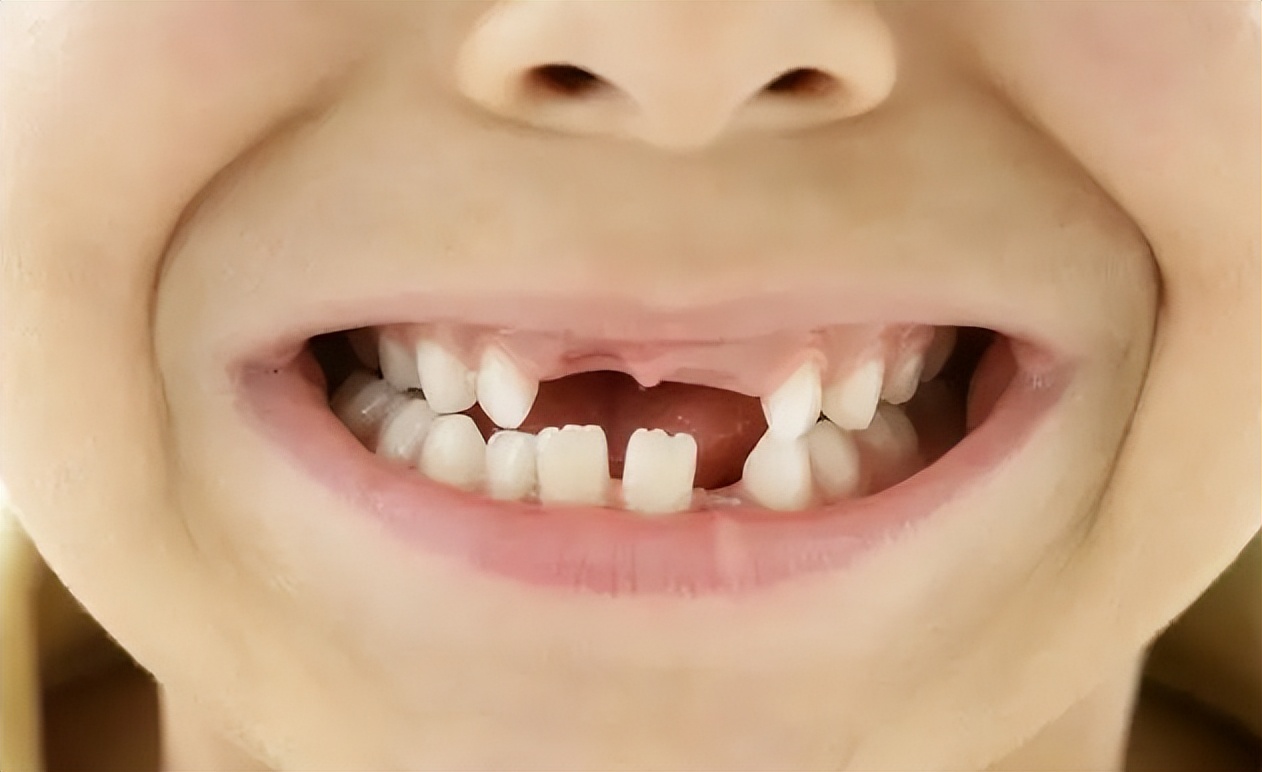 孩子换牙的时候牙齿长歪了要干预吗?