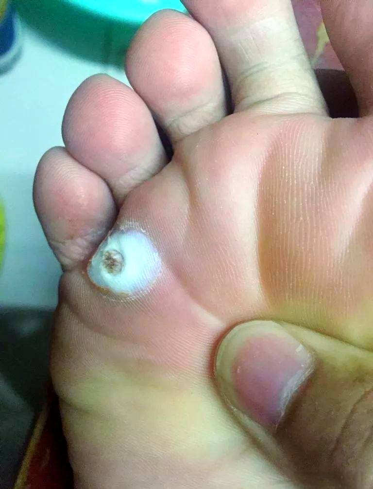 鸡眼与疣的区别及治疗方法详解