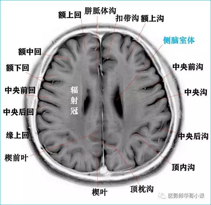 「高清mri图」颅脑磁共振mri解剖结构以及高清mr图谱