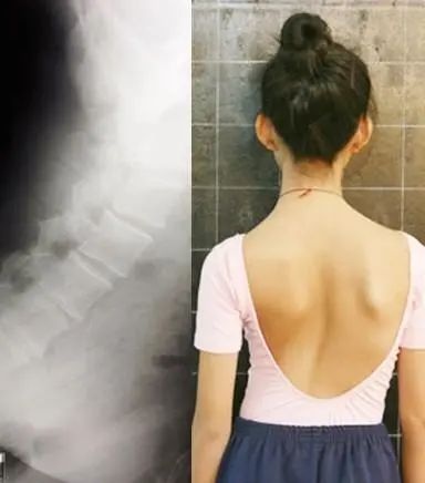 上海14岁女生背部植入20根长钉我国中小学生脊柱侧弯人数超500万