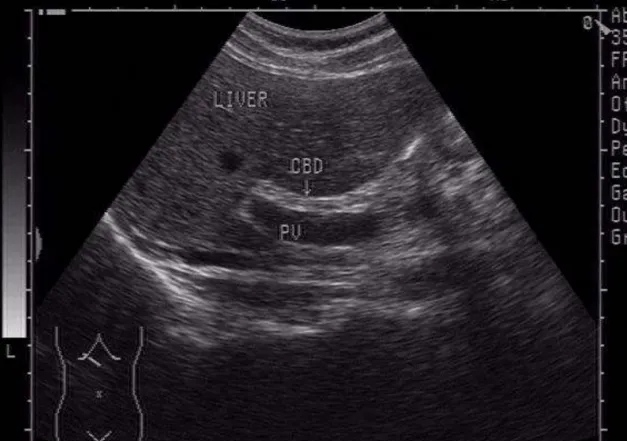 正常肝脏的超声图像及各项测量值概述