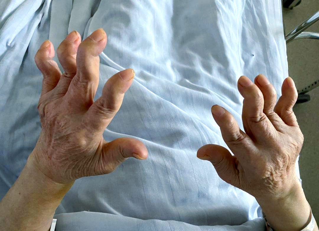 手指天鹅颈畸形:类风湿关节炎等导致的常见原因