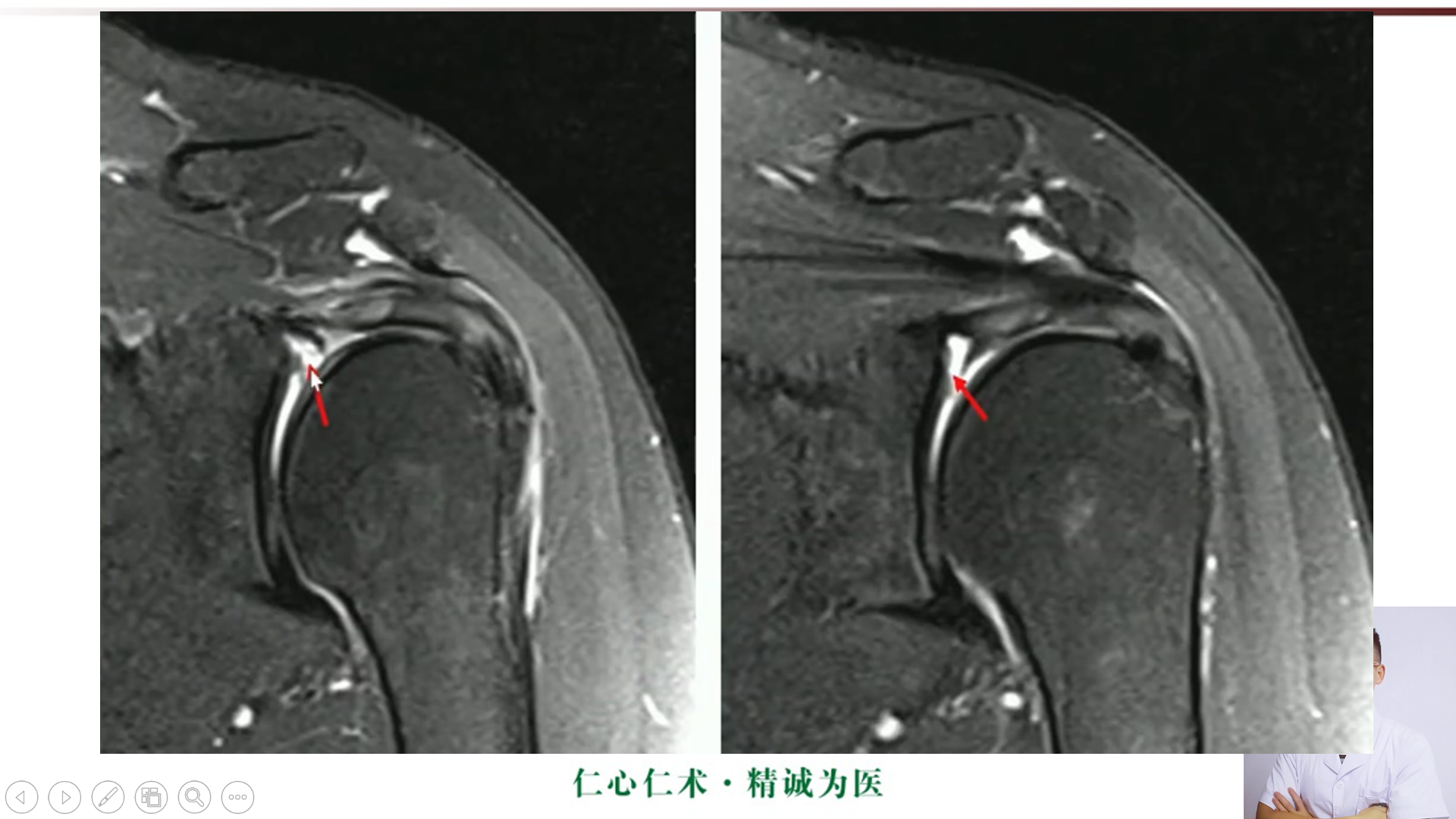 盂肱韧带mri解剖图片