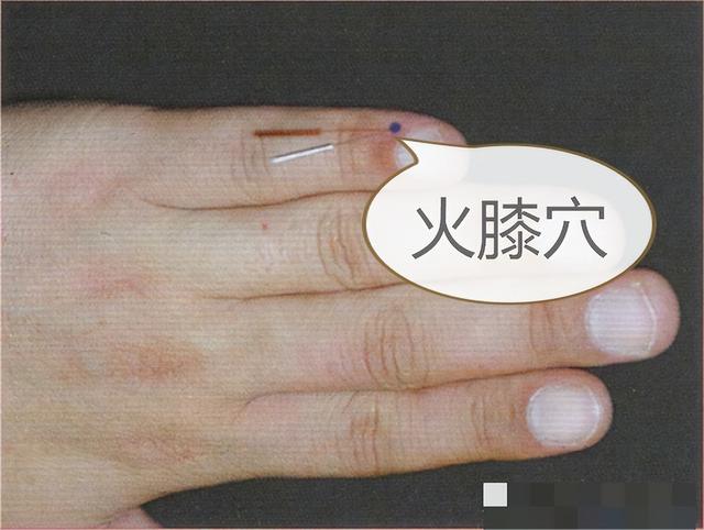 中医针灸穴位 火膝穴