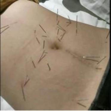 医生,我腰不好你怎么给我针灸肚子?