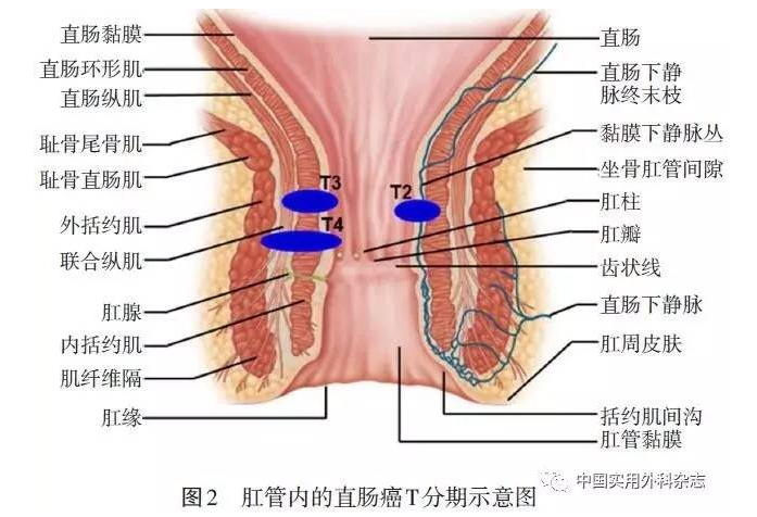 肛门齿状线位置图片图片