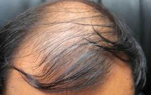 古芳栢草:男性脱发和女性脱发的区别在哪里?