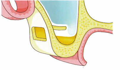 侧壁开窗上颌窦底提升术的手术方法