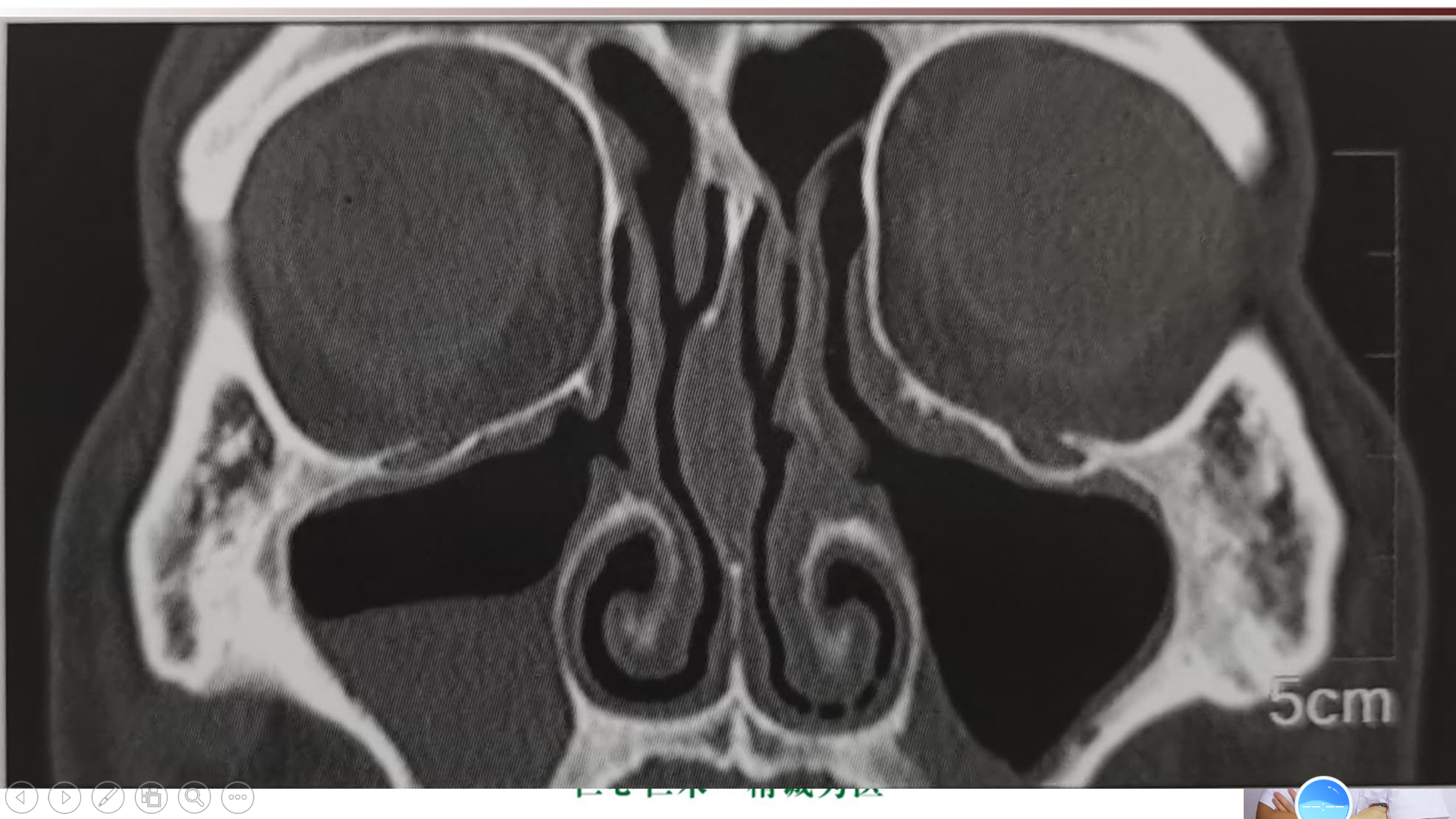 慢性鼻窦炎CT图片
