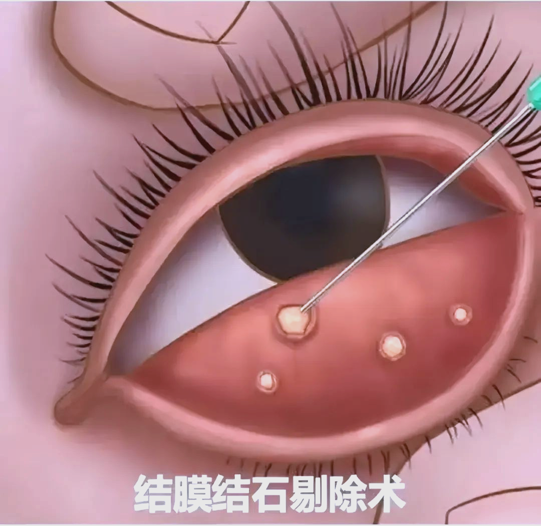 揭秘眼结石:成因,症状及预防策略详解