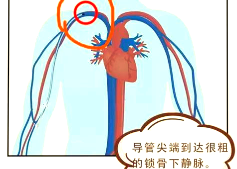 超声引导下中长导管:提升输液治疗的安全与舒适