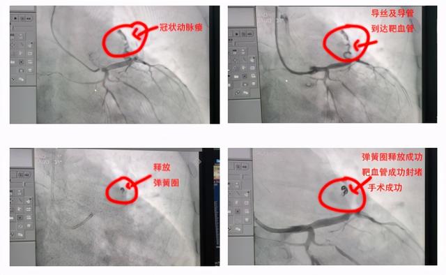 岳阳首例!"先天性冠状动脉瘘介入封堵术"在市二医院顺利开展