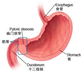 儿童幽门梗阻图片